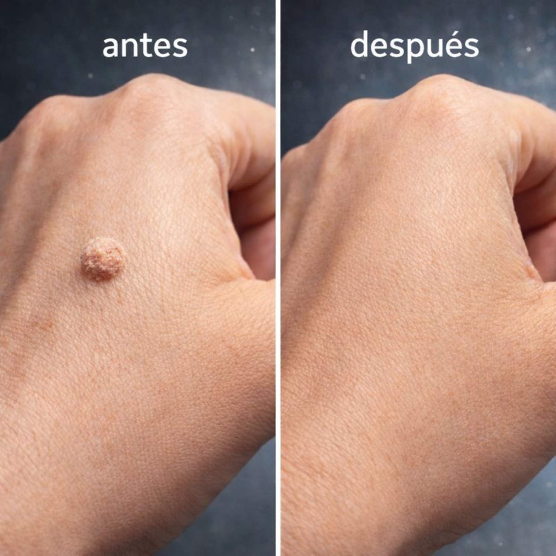 AHCC®-ELIMINADOR DE VERRUGAS CAUSADAS POR EL VPH (60 cápsulas).